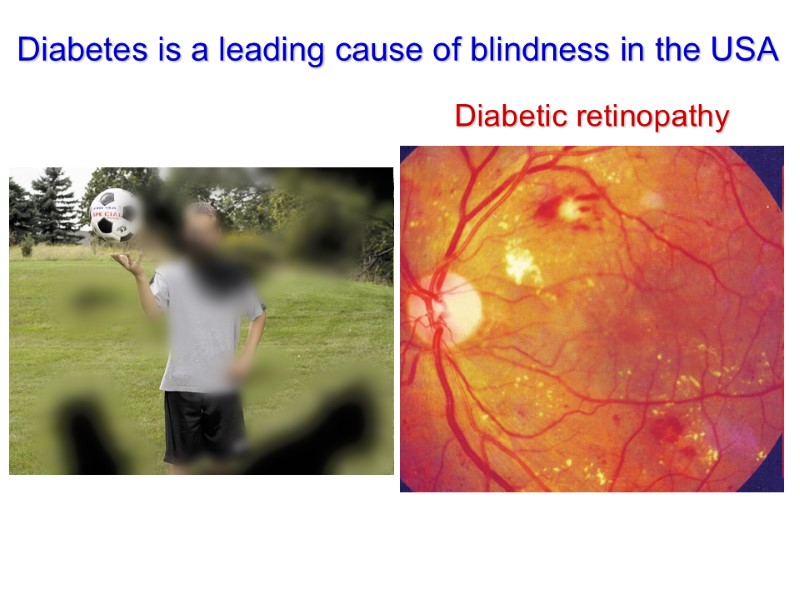 Diabetes is a leading cause of blindness in the USA Diabetic retinopathy